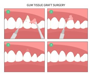gum graft surgery