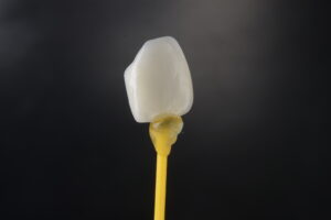 how much is it for veneers