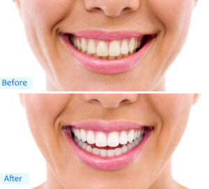 pearl teeth whitening & aesthetics