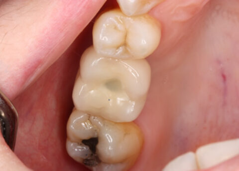 After 8W Sinus Tap Procedure - Access hole sealed with white filling material