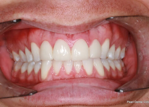 After - Full arch whitened_Emax veneers teeth
