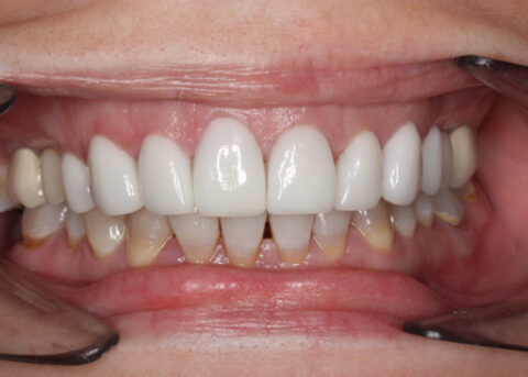 After - Full upper_lower arch teeth Emax veneer