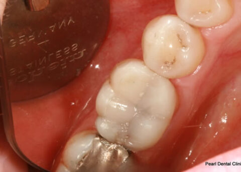 After Mercury Free White Fillings - Replacing mercury free white teeth fillings