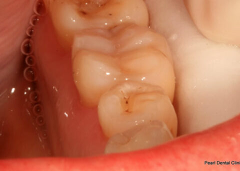 After Mercury Free White Fillings - Replacing with white fillings