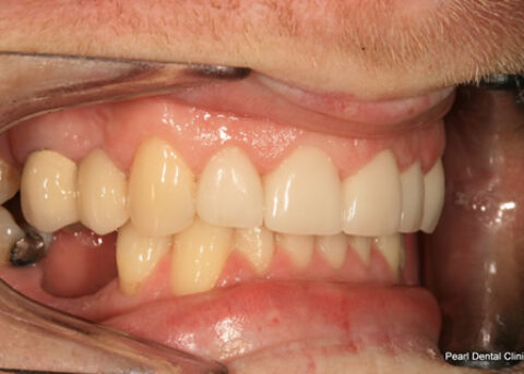 After Right full arch teeth smile makeover veneers_crown