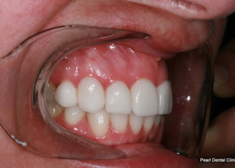 After - Right full arch upper_lower Emax Veneers