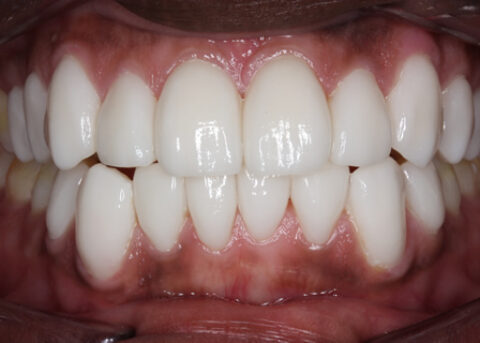 After Veneers - Fluorosis top_bottom teeth stain
