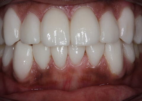After Veneers - Fluorosis upper_lower teeth stain_2