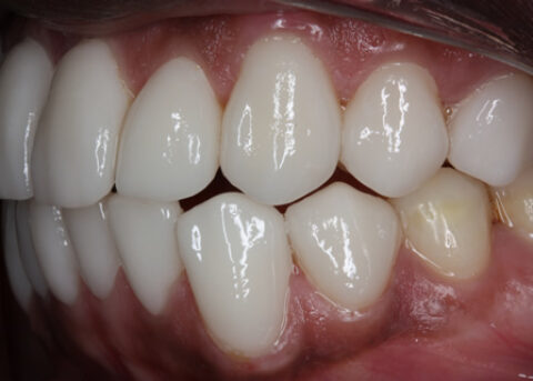 After Veneers - Left side fluorosis top_bottom teeth stain
