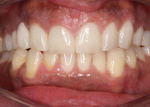 After Veneers_crowns - Full upper_lower arch teeth Emax veneers_crowns