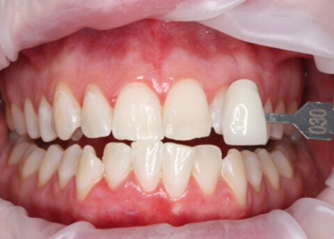 After Zoom Teeth Whitening - Zoom whitening