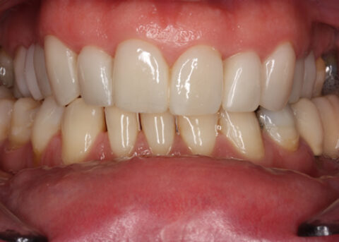 Upper_lower arch declined orthodontic treatment
