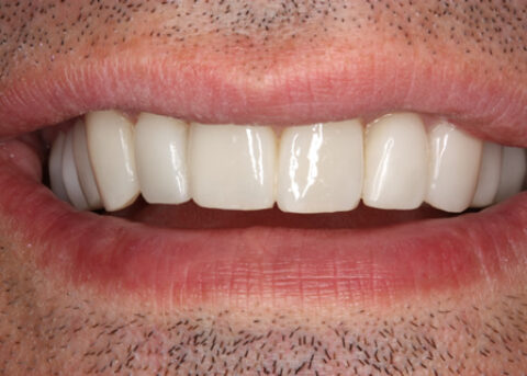 Ater teeth alignment_veneers - Front teeth look