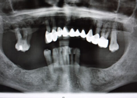 Full mouth Rehabilitation Implant - Upper_Lower teeth bone loss