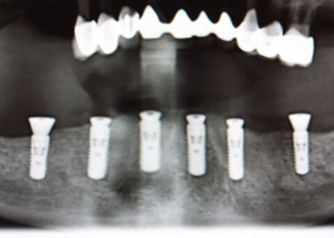 Full mouth Rehabilitation Implant - Upper_Lower teeth implant placement