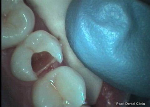 Before After Mercury Free White Fillings - Replacing teeth fillings