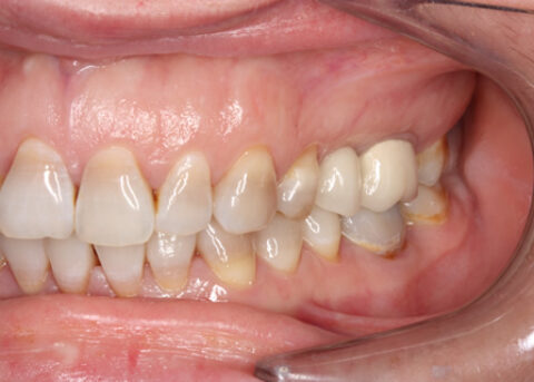 Before - Left full upper_lower arch teeth stain