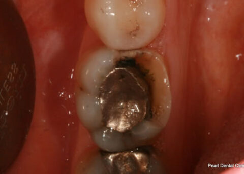 Before Mercury Free - Replacing teeth silver fillings