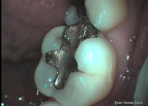 Before Mercury Free White Fillings - Replacing silver teeth fillings