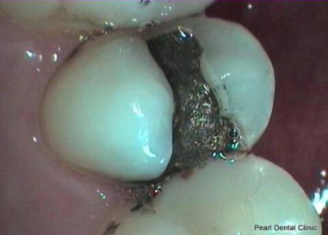 Before Mercury Free White Fillings - Replacing teeth fillings