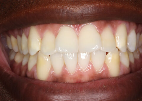 Before Veneers - Fluorosis top_bottom teeth stain