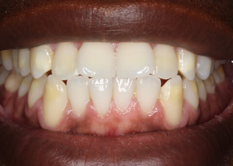 Before Veneers - Fluorosis upper_lower teeth stain