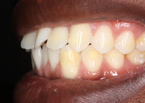 Before Veneers - Left side fluorosis top_bottom teeth stain