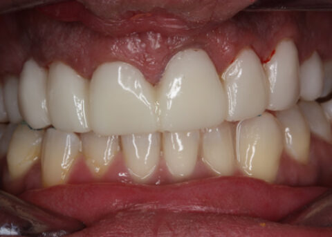 Before Veneers_crowns - Full upper_lower arch teeth temporary veneers_crowns