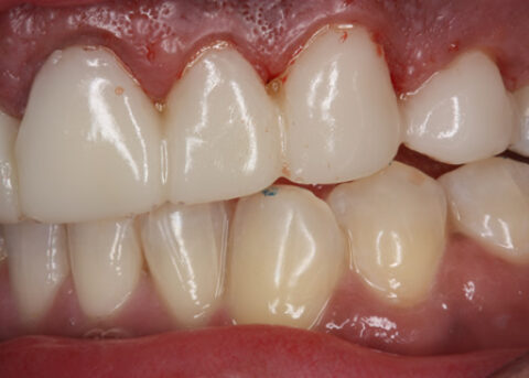 Before Veneers_crowns - Left side full upper_lower arch teeth temporary veneers_crown