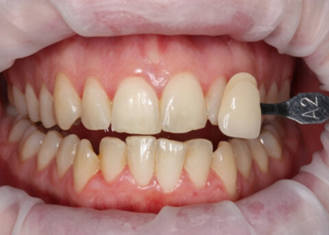 Before Image - Teeth Whitening