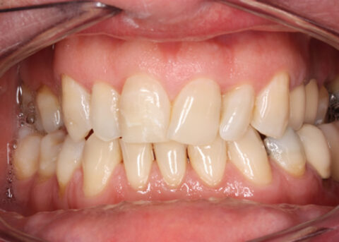 Before alignment_veneers - Upper_lower arch declined orthodontic treatment