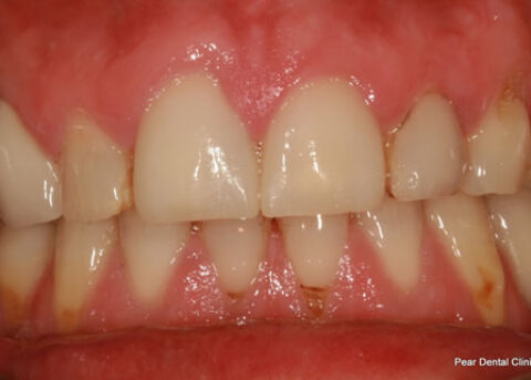 Broken Incisor Before After - Full arch teeth Emax Veneers
