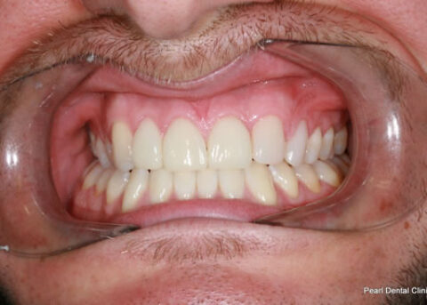 Composite Emax Posterior Veneer After - Full arch teeth