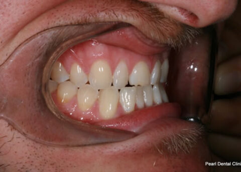 Composite Emax Posterior Veneer Before - Right full arch teeth