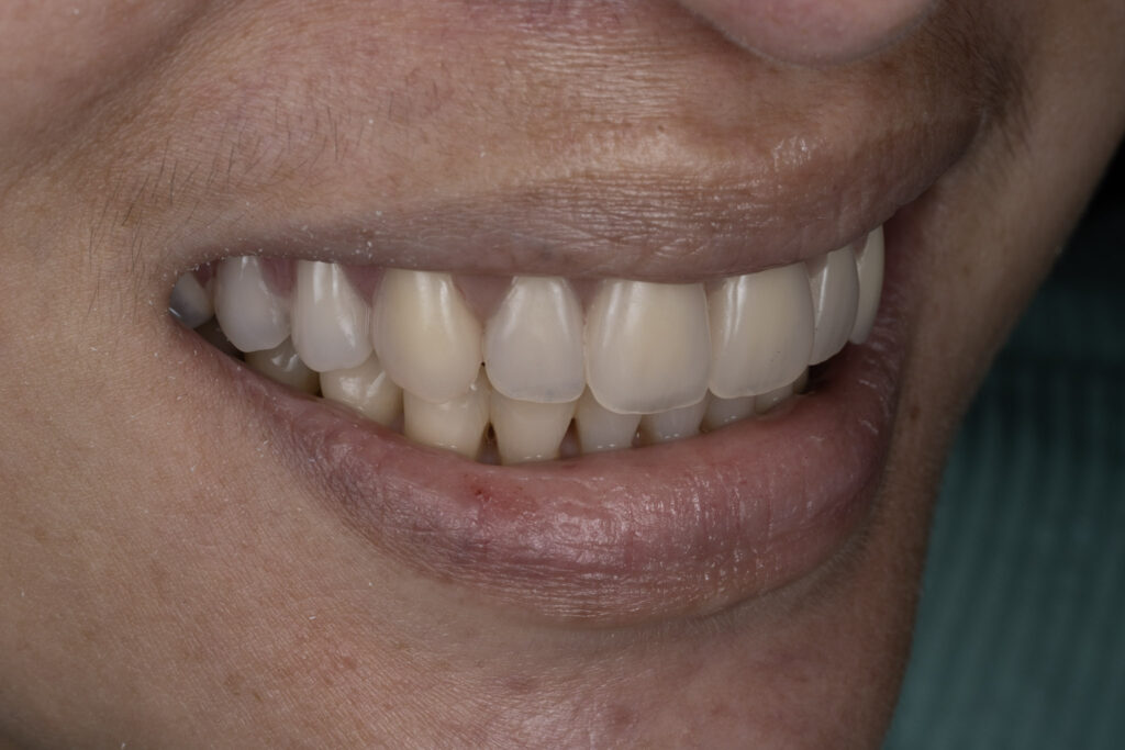 Cost of Full Mouth Dental Implants Specialist Prosthodontist