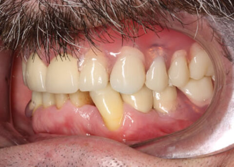 Denture and crown treatment