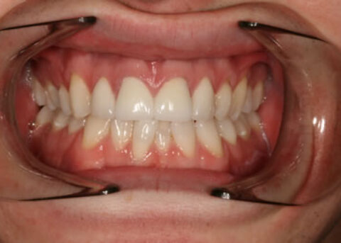 Emax Porcelain Veneers After - Full arch Emax veneers teeth