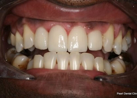 Emax Porcelain Veneers After - Full arch upper_bottom emax veneers teeth