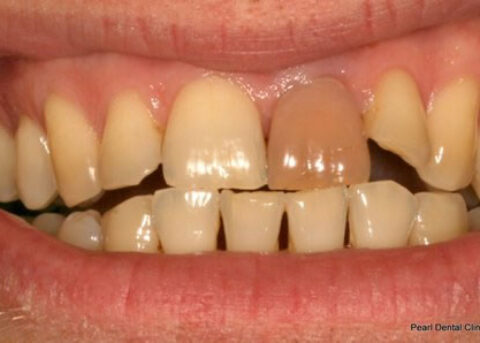 Emax Porcelain Veneers Before- Upper front teeth_2