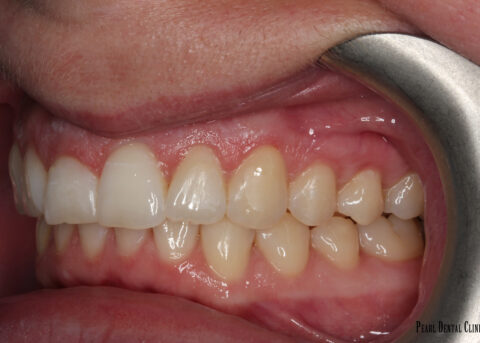 Invisalign Buccal left after