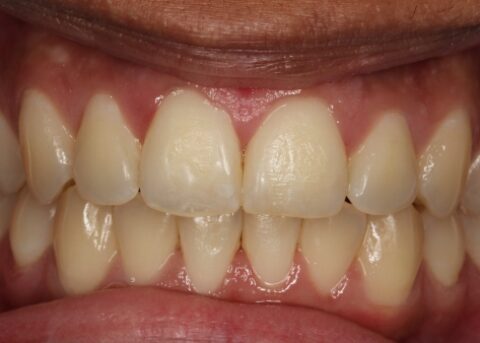 clear braces after treatment 1