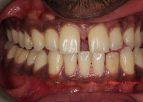 Composite veneers to close gap between front teeth.