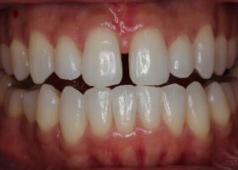 gaps between teeth