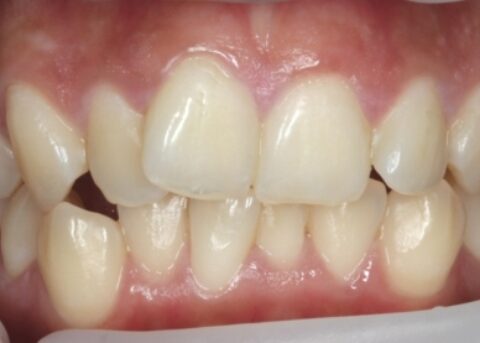 clear braces before treatmetn