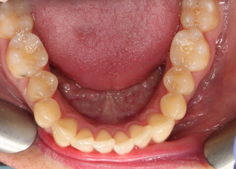 lower arch before invisalign