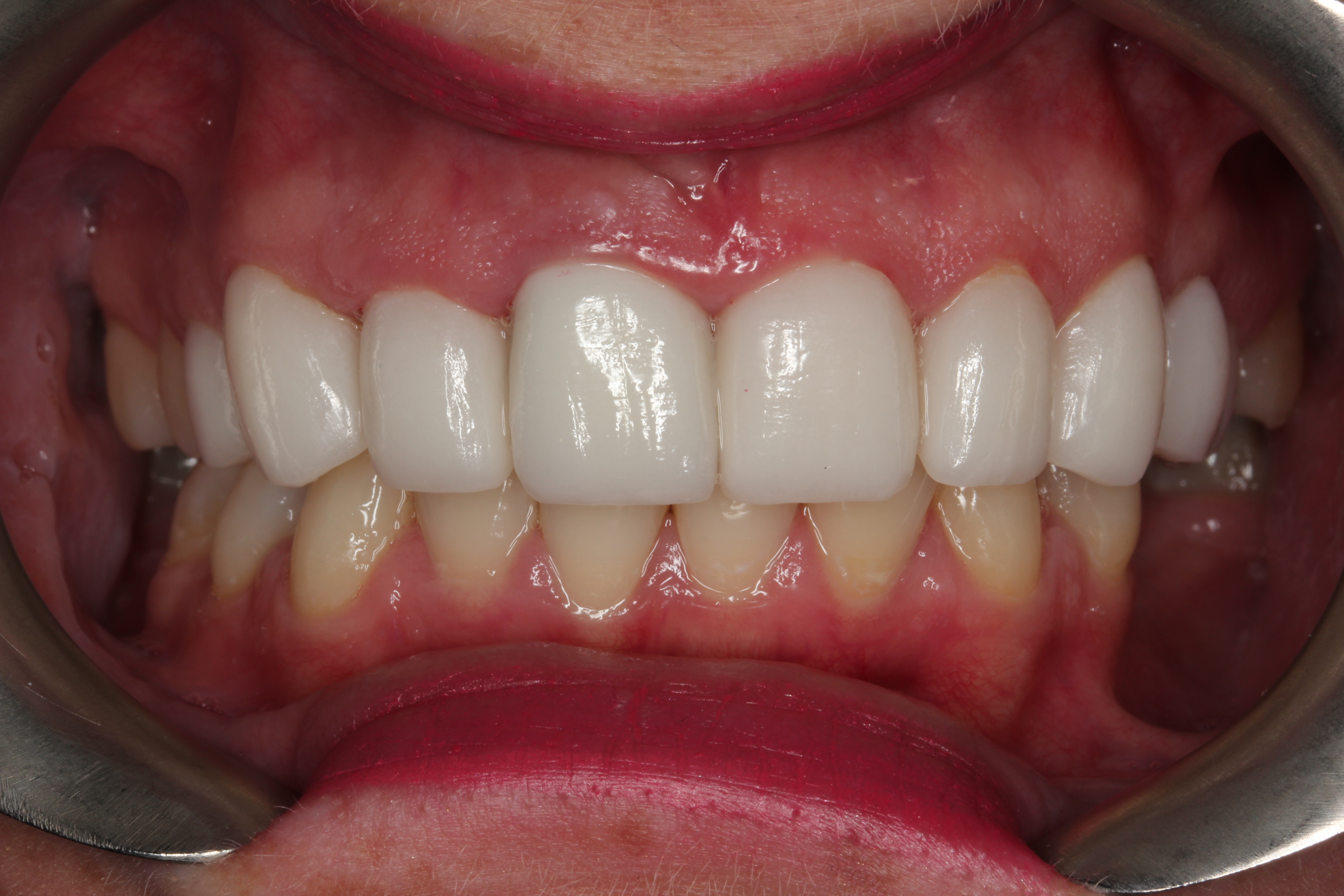 Emax Veneers