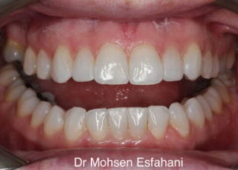 tooth recontouring