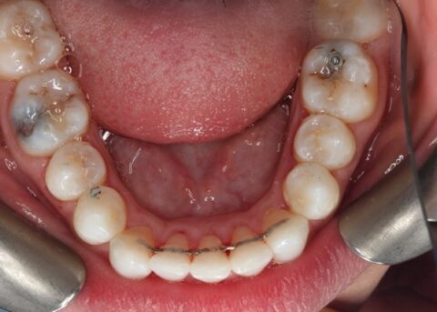 lower arch after invisalign