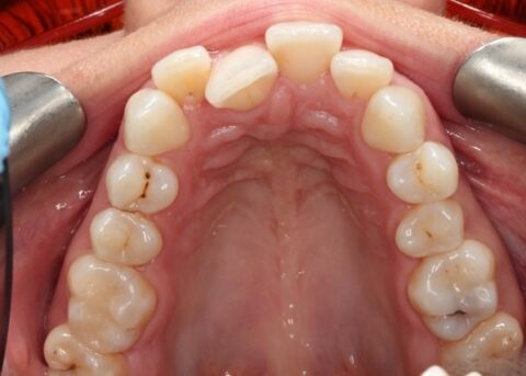 upper arch after invisalign