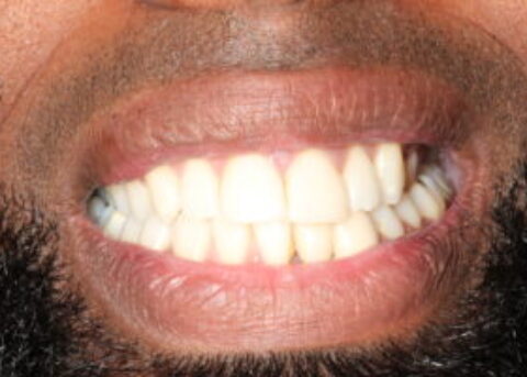 chipped incisors